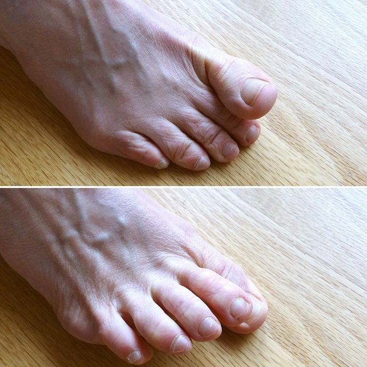 Plantar fasciitis exercises