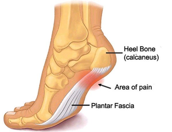 plantar fasciitis running