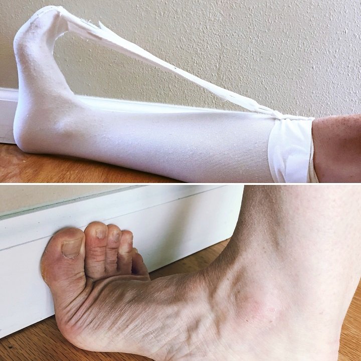  plantar fasciitis treatment