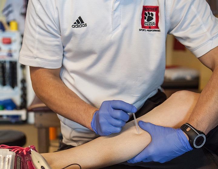 what is dry needling