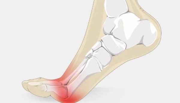 Metatarsalgia running